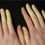 Syndrome de Raynaud Facteurs de risque et prévention