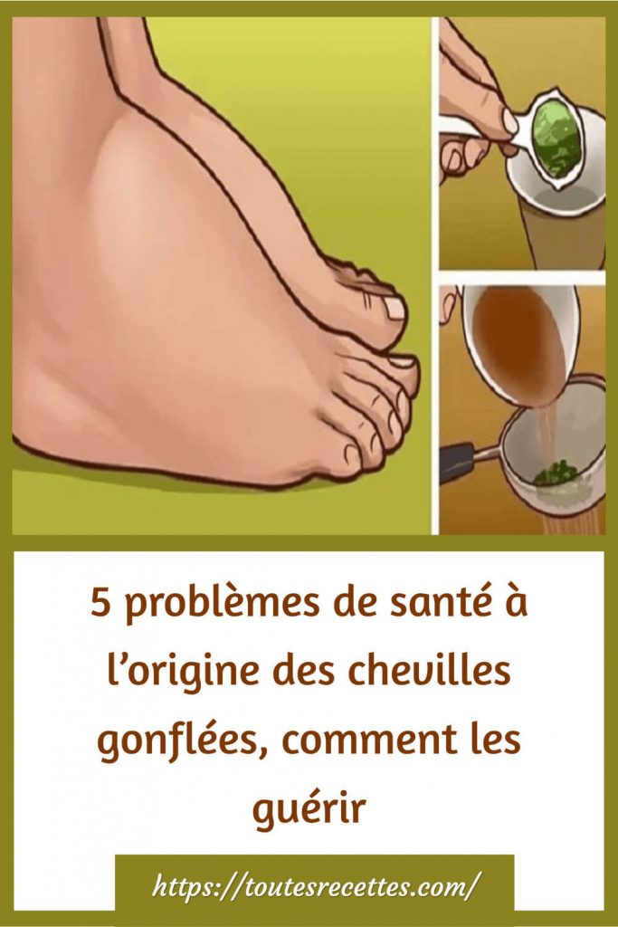 Comment préparer le Remède naturel contre l’enflure des chevilles et des jambes