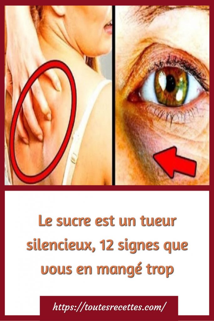 Le sucre est un tueur silencieux, 12 signes que vous en mangé trop