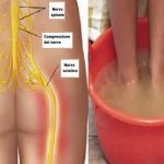 Méthode naturelle pour soulager la douleur du nerf sciatique