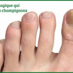 Remède magique qui élimine les champignons des pieds
