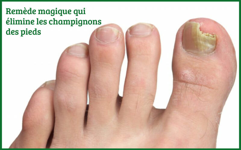 Remède magique qui élimine les champignons des pieds