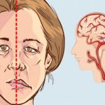 L’AVC est un tueur silencieux 10 signes à reconnaître