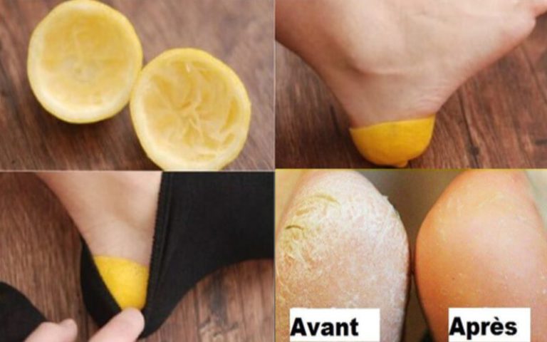 Astuce efficace pour se débarrasser de talons laids et gercés