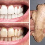 Gingembre, sel permettent de blanchir les dents comment les utiliser