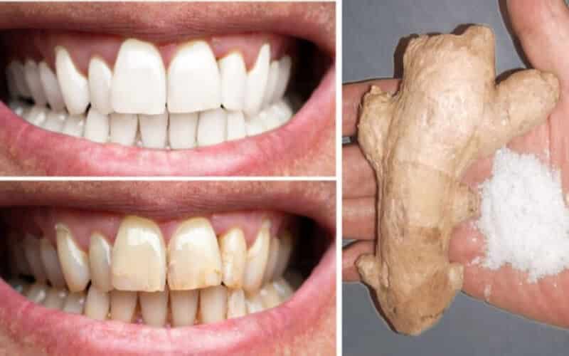 Gingembre, sel permettent de blanchir les dents comment les utiliser